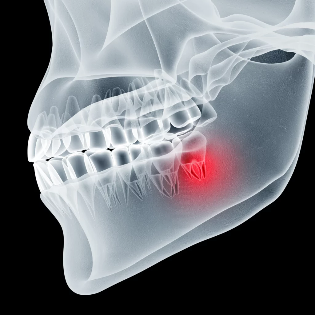 wisdom teeth removal in Monroe, CT