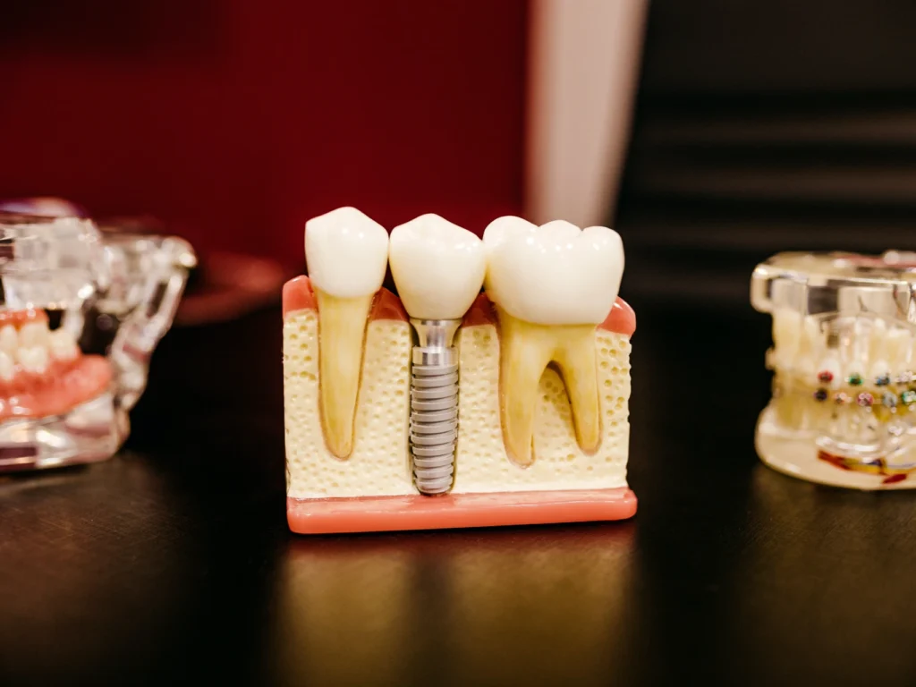 model of a single tooth dental implant | cost of dental implants in Monroe, CT