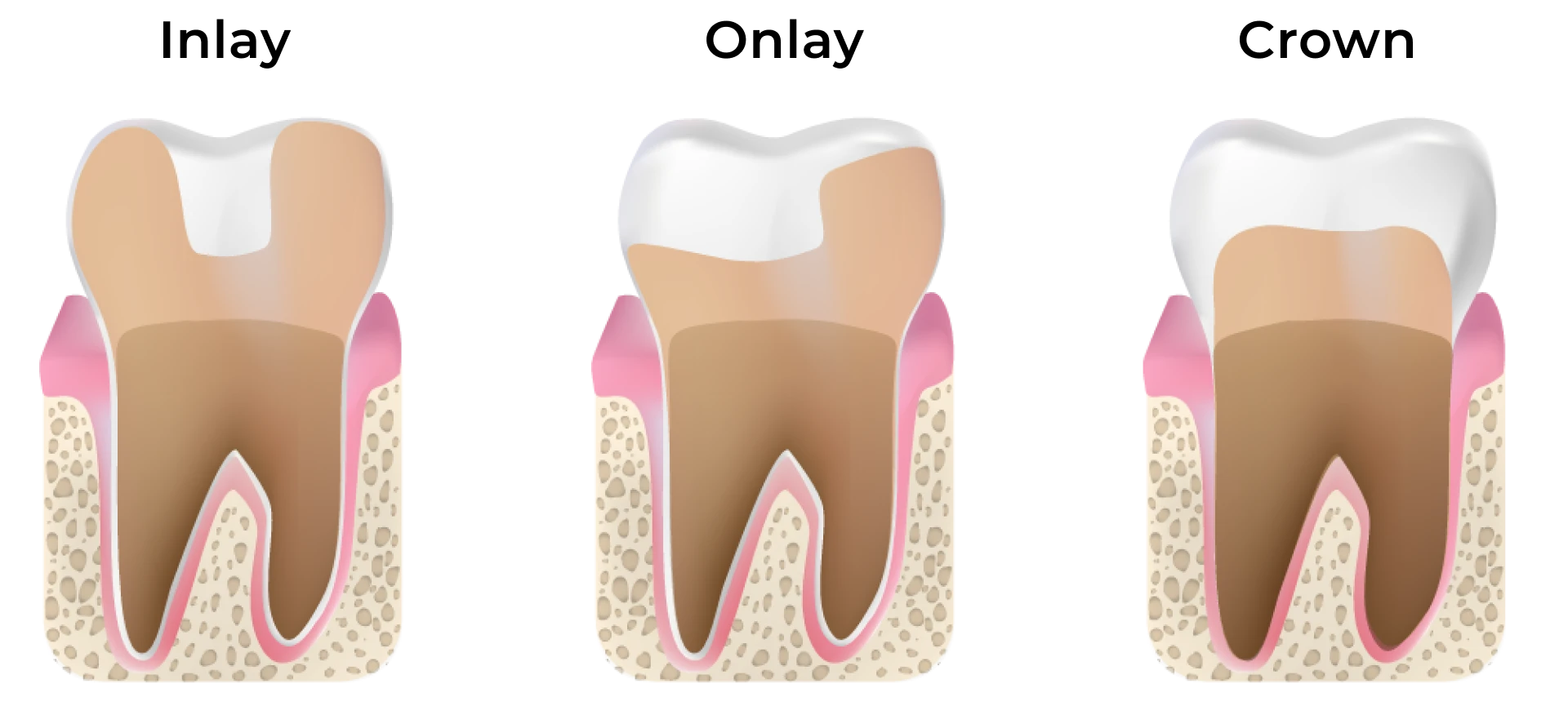 graphic of inlay vs onlay vs crown | inlays and onlays
