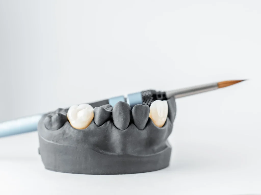 jaw model with porcelain dental crowns