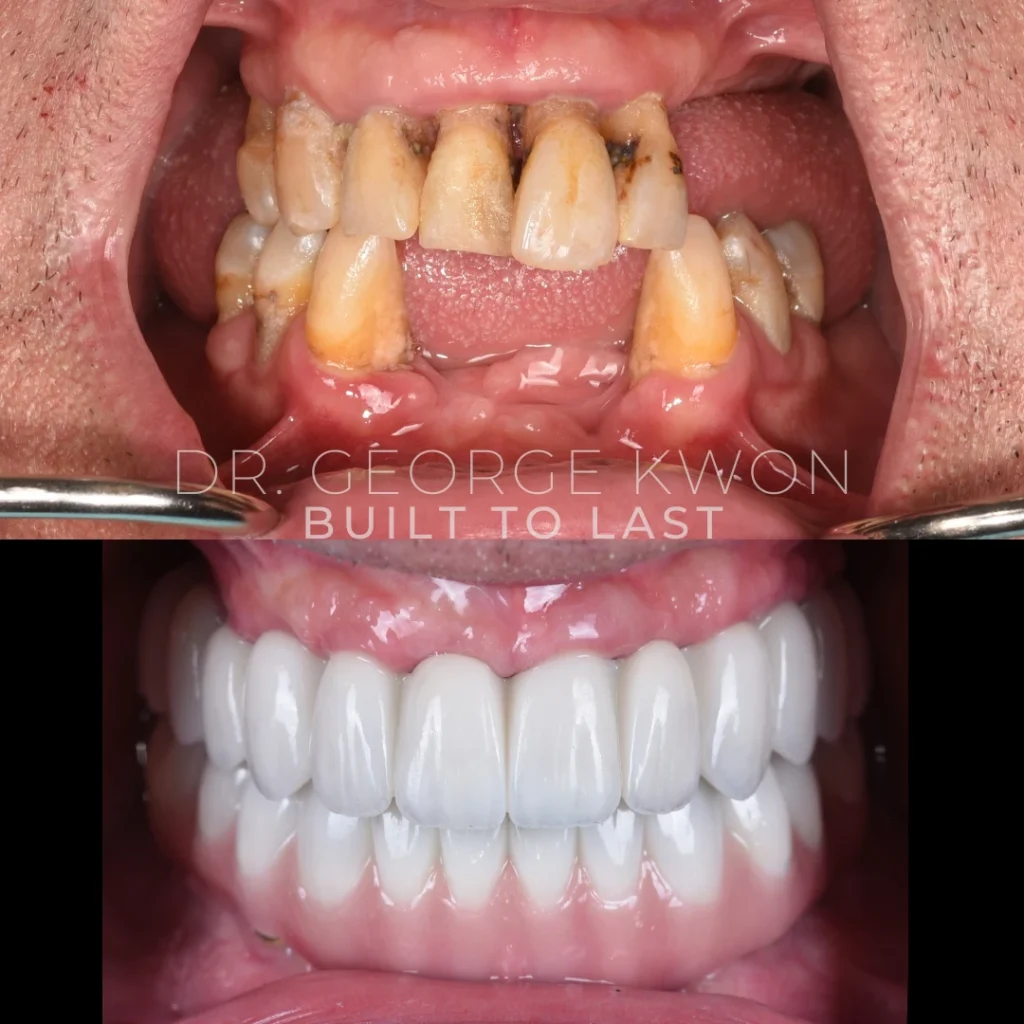 Before and after All-On-4 dental implants in Monroe, CT at Monroe Smiles