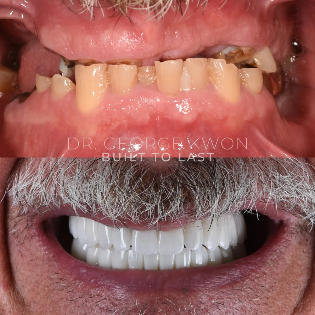 Before and after All-On-4 dental implants in Monroe, CT at Monroe Smiles