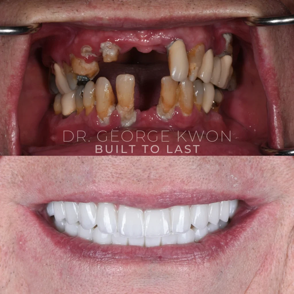 Before and after All-On-4 dental implants in Monroe, CT at Monroe Smiles