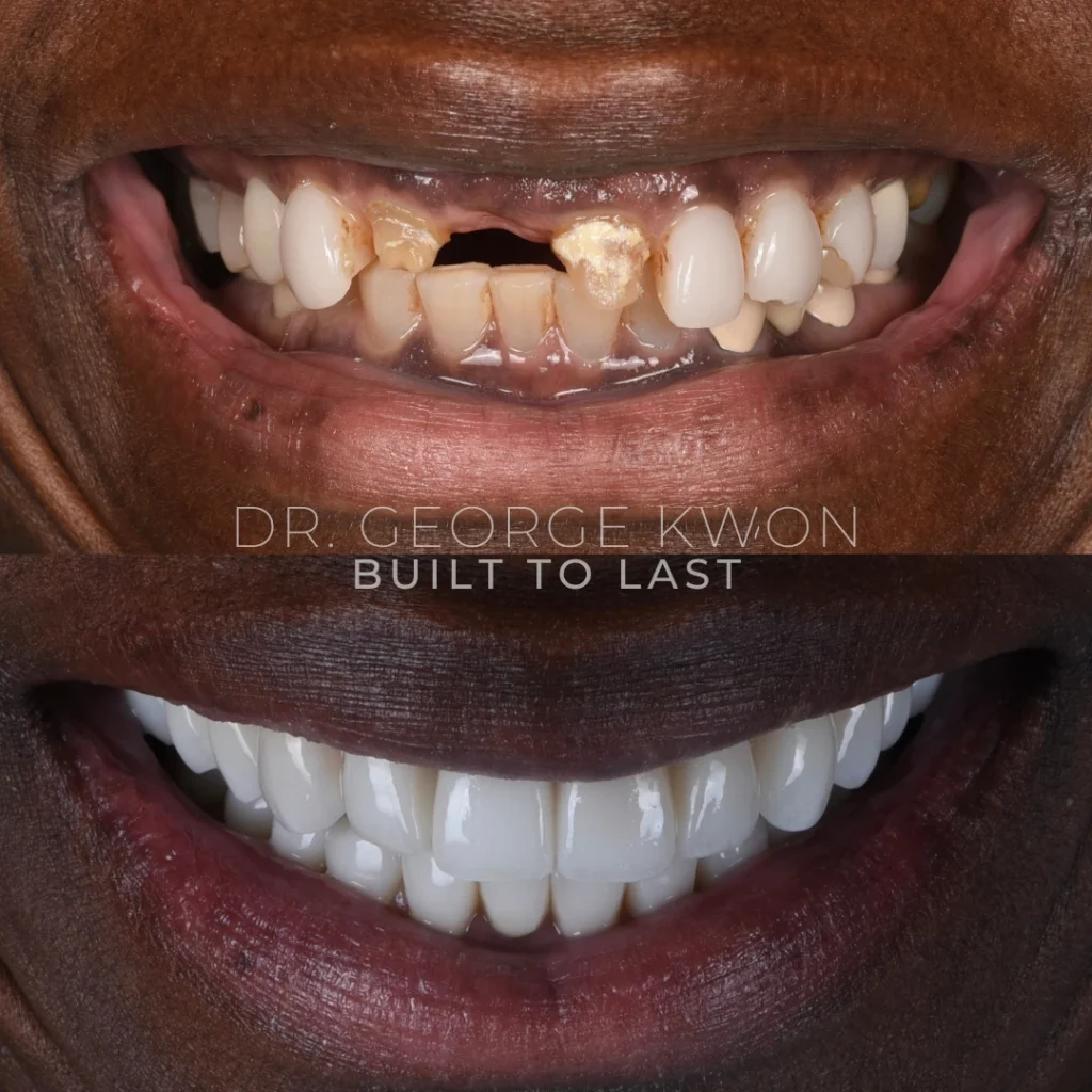 Before and after a smile makeover in Monroe, CT at Monroe Smiles