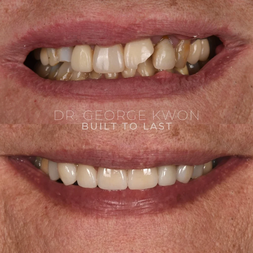 Before and after a smile makeover in Monroe, CT at Monroe Smiles